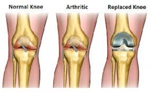 Doctor for knee pain in Indore | Knee specialist in Indore